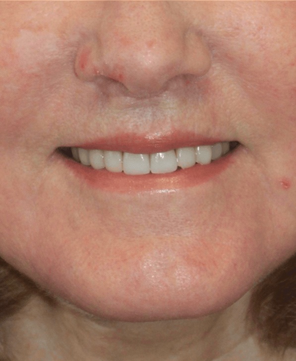 lip lift, fat grafting, patient after treatment