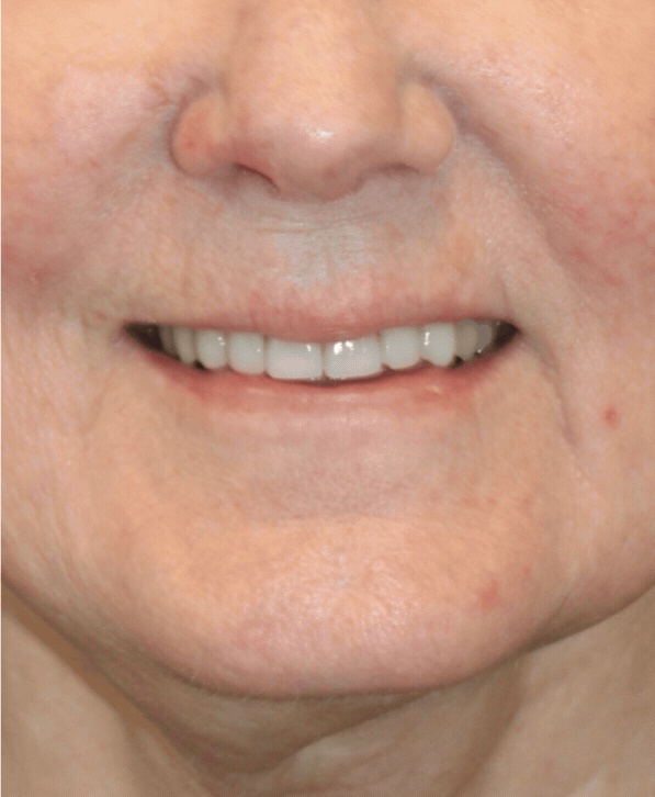 lip lift, fat grafting, patient before treatment