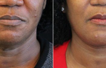 62 year-old before and 5 months after The Maia Method: Deep Plane Facelift, Neck Lift, Buccal Fat Reduction, Brow Resetting (Gentle Brow Lift), and 3 Sessions of Clear+Brilliant Laser