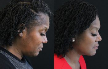 62 year-old before and 5 months after The Maia Method: Deep Plane Facelift, Neck Lift, Buccal Fat Reduction, Brow Resetting (Gentle Brow Lift), and 3 Sessions of Clear+Brilliant Laser