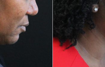 62 year-old before and 5 months after The Maia Method: Deep Plane Facelift, Neck Lift, Buccal Fat Reduction, Brow Resetting (Gentle Brow Lift), and 3 Sessions of Clear+Brilliant Laser