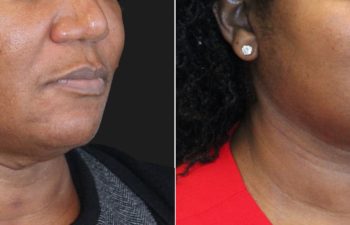 62 year-old before and 5 months after The Maia Method: Deep Plane Facelift, Neck Lift, Buccal Fat Reduction, Brow Resetting (Gentle Brow Lift), and 3 Sessions of Clear+Brilliant Laser