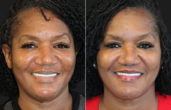 62 year-old before and 5 months after The Maia Method: Deep Plane Facelift, Neck Lift, Buccal Fat Reduction, Brow Resetting (Gentle Brow Lift), and 3 Sessions of Clear+Brilliant Laser