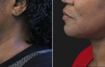 62 year-old before and 5 months after The Maia Method: Deep Plane Facelift, Neck Lift, Buccal Fat Reduction, Brow Resetting (Gentle Brow Lift), and 3 Sessions of Clear+Brilliant Laser