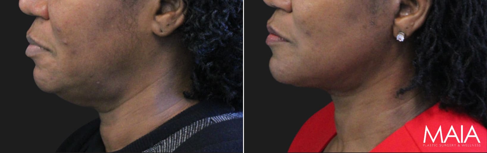 62 year-old before and 5 months after The Maia Method: Deep Plane Facelift, Neck Lift, Buccal Fat Reduction, Brow Resetting (Gentle Brow Lift), and 3 Sessions of Clear+Brilliant Laser