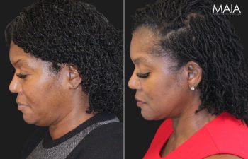 62 year-old before and 5 months after The Maia Method: Deep Plane Facelift, Neck Lift, Buccal Fat Reduction, Brow Resetting (Gentle Brow Lift), and 3 Sessions of Clear+Brilliant Laser