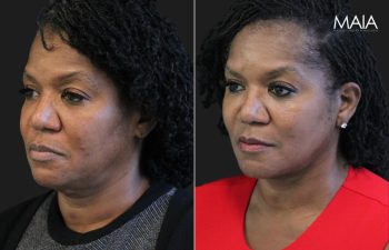 62 year-old before and 5 months after The Maia Method: Deep Plane Facelift, Neck Lift, Buccal Fat Reduction, Brow Resetting (Gentle Brow Lift), and 3 Sessions of Clear+Brilliant Laser