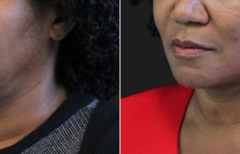 62 year-old before and 5 months after The Maia Method: Deep Plane Facelift, Neck Lift, Buccal Fat Reduction, Brow Resetting (Gentle Brow Lift), and 3 Sessions of Clear+Brilliant Laser