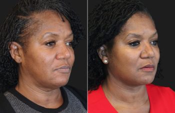 62 year-old before and 5 months after The Maia Method: Deep Plane Facelift, Neck Lift, Buccal Fat Reduction, Brow Resetting (Gentle Brow Lift), and 3 Sessions of Clear+Brilliant Laser