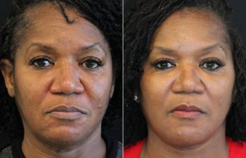 62 year-old before and 5 months after The Maia Method: Deep Plane Facelift, Neck Lift, Buccal Fat Reduction, Brow Resetting (Gentle Brow Lift), and 3 Sessions of Clear+Brilliant Laser