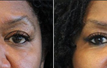 62 year-old before and 5 months after The Maia Method: Deep Plane Facelift, Neck Lift, Buccal Fat Reduction, Brow Resetting (Gentle Brow Lift), and 3 Sessions of Clear+Brilliant Laser