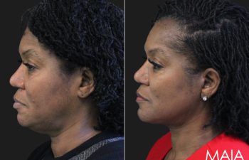 62 year-old before and 5 months after The Maia Method: Deep Plane Facelift, Neck Lift, Buccal Fat Reduction, Brow Resetting (Gentle Brow Lift), and 3 Sessions of Clear+Brilliant Laser