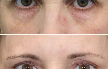 49 year-old before and 6 weeks after The Maia Method: Deep Plane Facelift, Neck Lift, Gentle Brow Lift, and Fat Grafting to the Face.