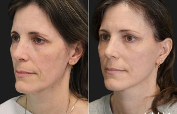 49 year-old before and 6 weeks after The Maia Method: Deep Plane Facelift, Neck Lift, Gentle Brow Lift, and Fat Grafting to the Face.