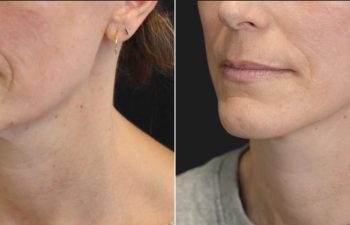 49 year-old before and 6 weeks after The Maia Method: Deep Plane Facelift, Neck Lift, Gentle Brow Lift, and Fat Grafting to the Face.