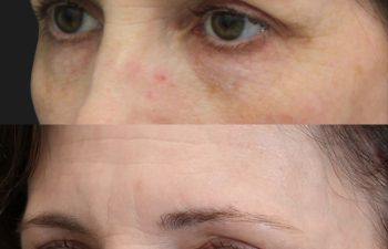 49 year-old before and 6 weeks after The Maia Method: Deep Plane Facelift, Neck Lift, Gentle Brow Lift, and Fat Grafting to the Face.