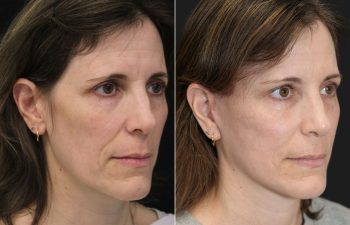 49 year-old before and 6 weeks after The Maia Method: Deep Plane Facelift, Neck Lift, Gentle Brow Lift, and Fat Grafting to the Face.