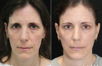 49 year-old before and 6 weeks after The Maia Method: Deep Plane Facelift, Neck Lift, Gentle Brow Lift, and Fat Grafting to the Face.