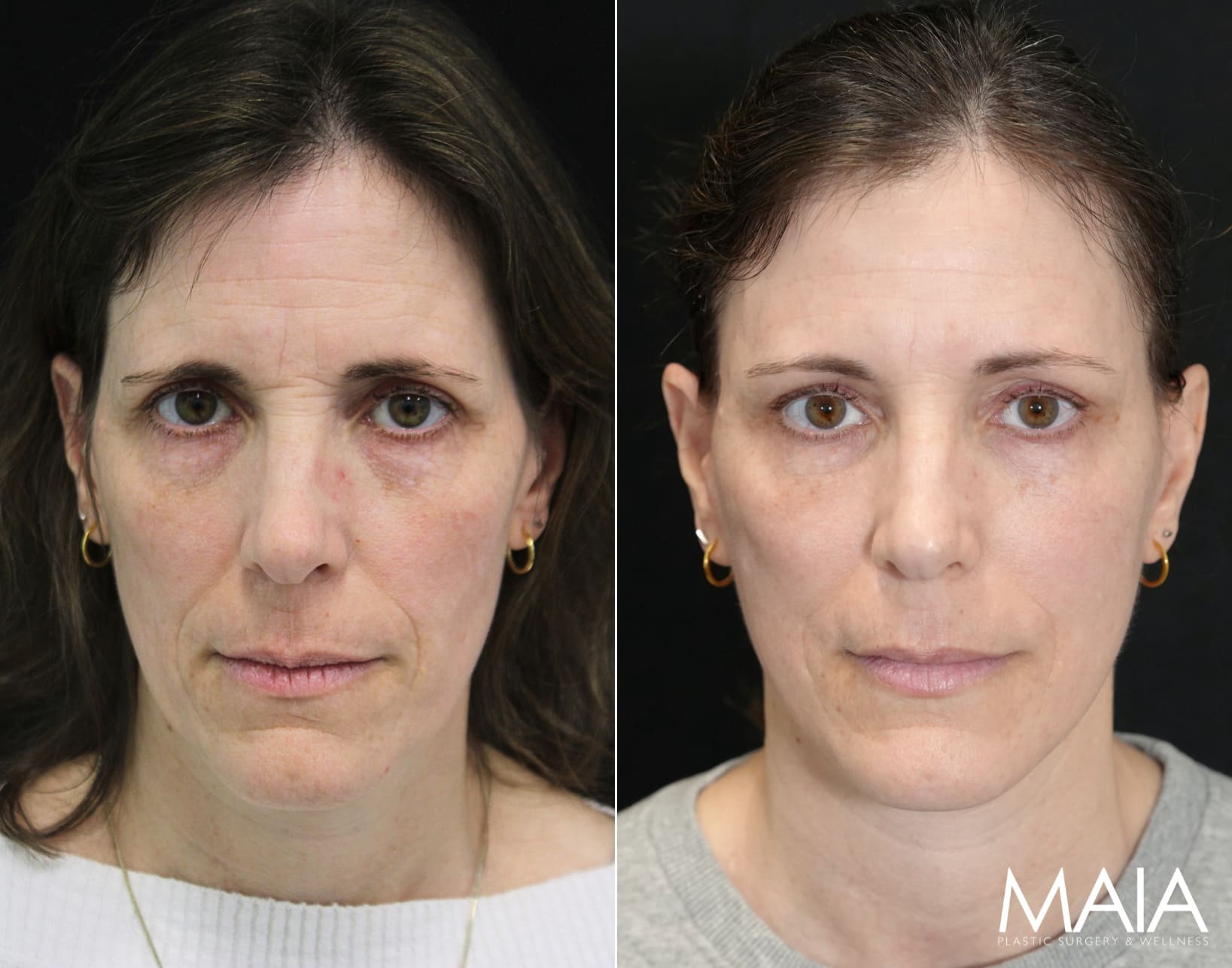 49 year-old before and 6 weeks after The Maia Method: Deep Plane Facelift, Neck Lift, Gentle Brow Lift, and Fat Grafting to the Face.