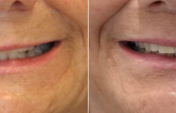 65 year-old patient before and after gentle lip lift.