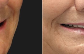 65 year-old patient before and after gentle lip lift.
