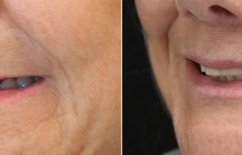 65 year-old patient before and after gentle lip lift.
