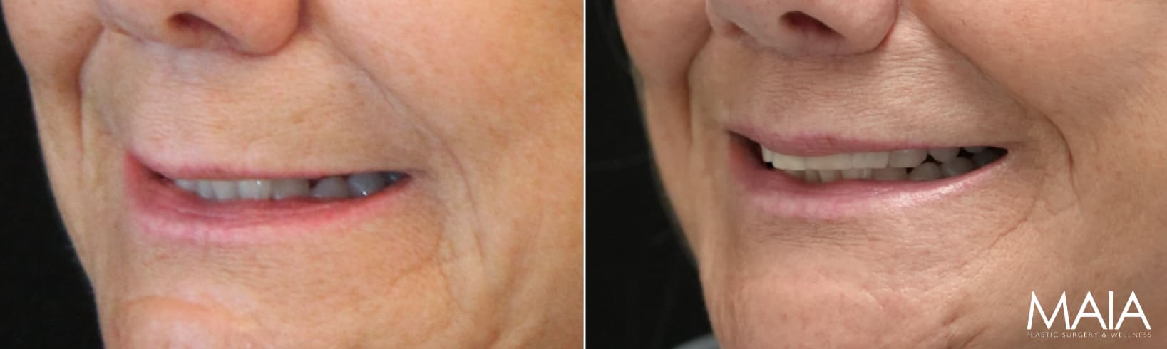 65 year-old patient before and after gentle lip lift.