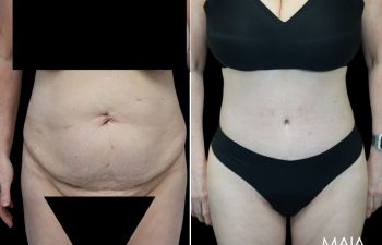55 year-old before and after Mommy Makeover with Dr. Maia: Extended Tummy Tuck, Flank Liposuction, Mini BBL (Fat Grafting to The Buttocks)