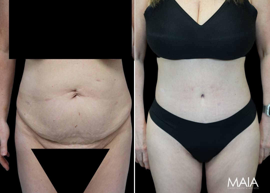 55 year-old before and after Mommy Makeover with Dr. Maia: Extended Tummy Tuck, Flank Liposuction, Mini BBL (Fat Grafting to The Buttocks)