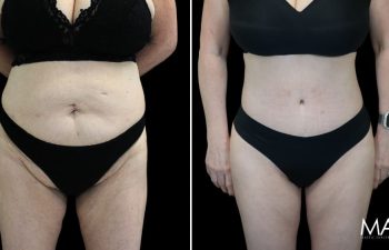 55 year-old before and after Mommy Makeover with Dr. Maia: Extended Tummy Tuck, Flank Liposuction, Mini BBL (Fat Grafting to The Buttocks)
