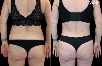 55 year-old before and after Mommy Makeover with Dr. Maia: Extended Tummy Tuck, Flank Liposuction, Mini BBL (Fat Grafting to The Buttocks)