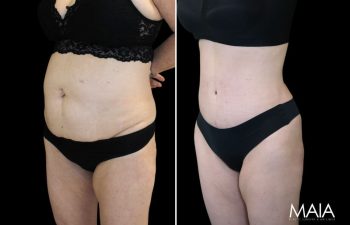 55 year-old before and after Mommy Makeover with Dr. Maia: Extended Tummy Tuck, Flank Liposuction, Mini BBL (Fat Grafting to The Buttocks)