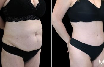 55 year-old before and after Mommy Makeover with Dr. Maia: Extended Tummy Tuck, Flank Liposuction, Mini BBL (Fat Grafting to The Buttocks)