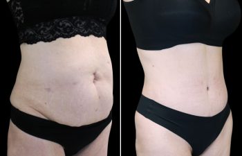 55 year-old before and after Mommy Makeover with Dr. Maia: Extended Tummy Tuck, Flank Liposuction, Mini BBL (Fat Grafting to The Buttocks)