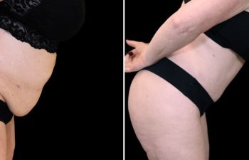 55 year-old before and after Mommy Makeover with Dr. Maia: Extended Tummy Tuck, Flank Liposuction, Mini BBL (Fat Grafting to The Buttocks)