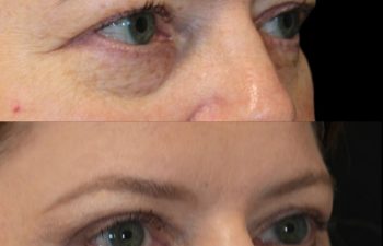 55 Year-Old Before and 4 Months After Eye Rejuvenation with Dr. Maia: Upper Eyelid Lift, Lower Blepharoplasty, Temple Lift, Fat & Nanofat Grafting Around the Eyes.