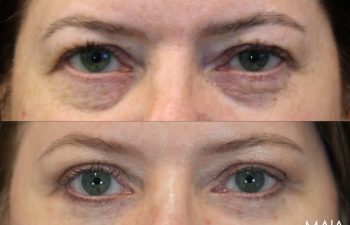 55 Year-Old Before and 4 Months After Eye Rejuvenation with Dr. Maia: Upper Eyelid Lift, Lower Blepharoplasty, Temple Lift, Fat & Nanofat Grafting Around the Eyes.