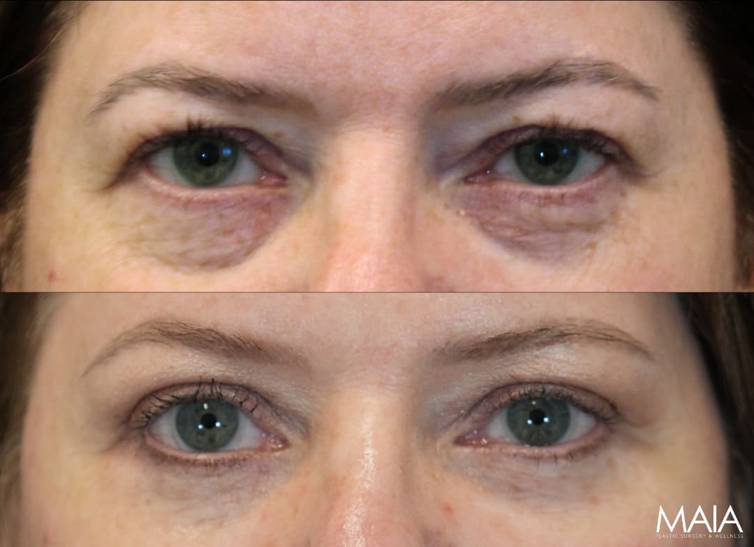 55 Year-Old Before and 4 Months After Eye Rejuvenation with Dr. Maia: Upper Eyelid Lift, Lower Blepharoplasty, Temple Lift, Fat & Nanofat Grafting Around the Eyes.