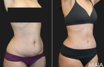 36 year old before and 1 month after Abdominoplasty