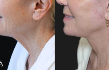 68 year-old patient before and 7 months after The Maia Method by Dr. Munqiue Maia.