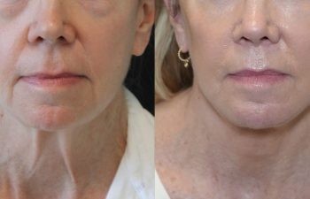 68 year-old patient before and 7 months after The Maia Method by Dr. Munqiue Maia.
