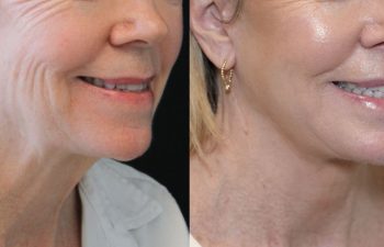 68 year-old patient before and 7 months after The Maia Method by Dr. Munqiue Maia.