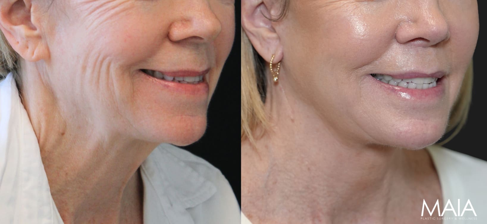 68 year-old patient before and 7 months after The Maia Method by Dr. Munqiue Maia.