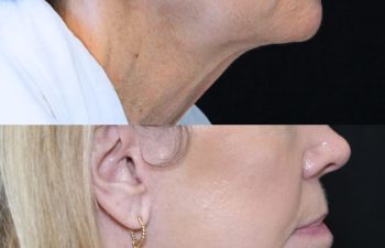 68 year-old patient before and 7 months after The Maia Method by Dr. Munqiue Maia.