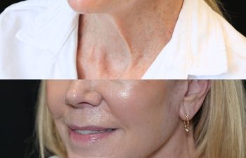 68 year-old patient before and 7 months after The Maia Method by Dr. Munqiue Maia.