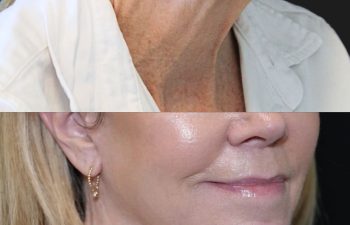 68 year-old patient before and 7 months after The Maia Method by Dr. Munqiue Maia.