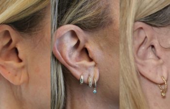 68 year-old patient before and 7 months after The Maia Method by Dr. Munqiue Maia.