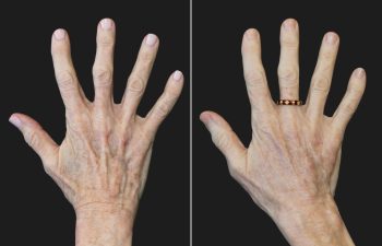 68 year-old patient before and 7 months after The Maia Method by Dr. Munqiue Maia.