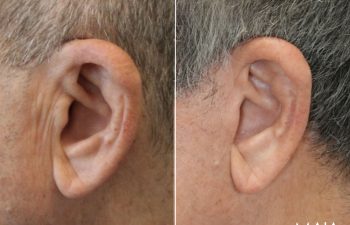 70 year-old male before and 1 year after deep plane facelift, neck lift, temple lift, fat grafting, and nanofat grafting.