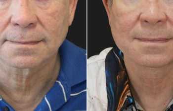 70 year-old male before and 1 year after deep plane facelift, neck lift, temple lift, fat grafting, and nanofat grafting.